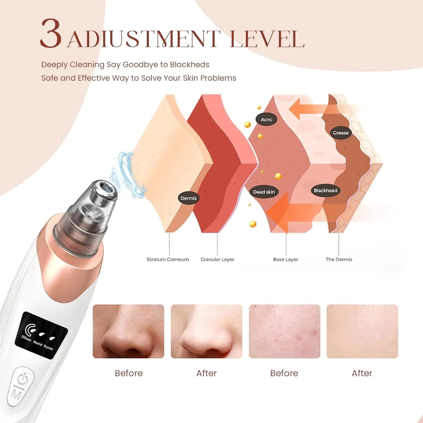 Rechargeable Blackhead Remover Vacuum – Powerful Pore Cleaner & Acne Extractor for Face & Nose